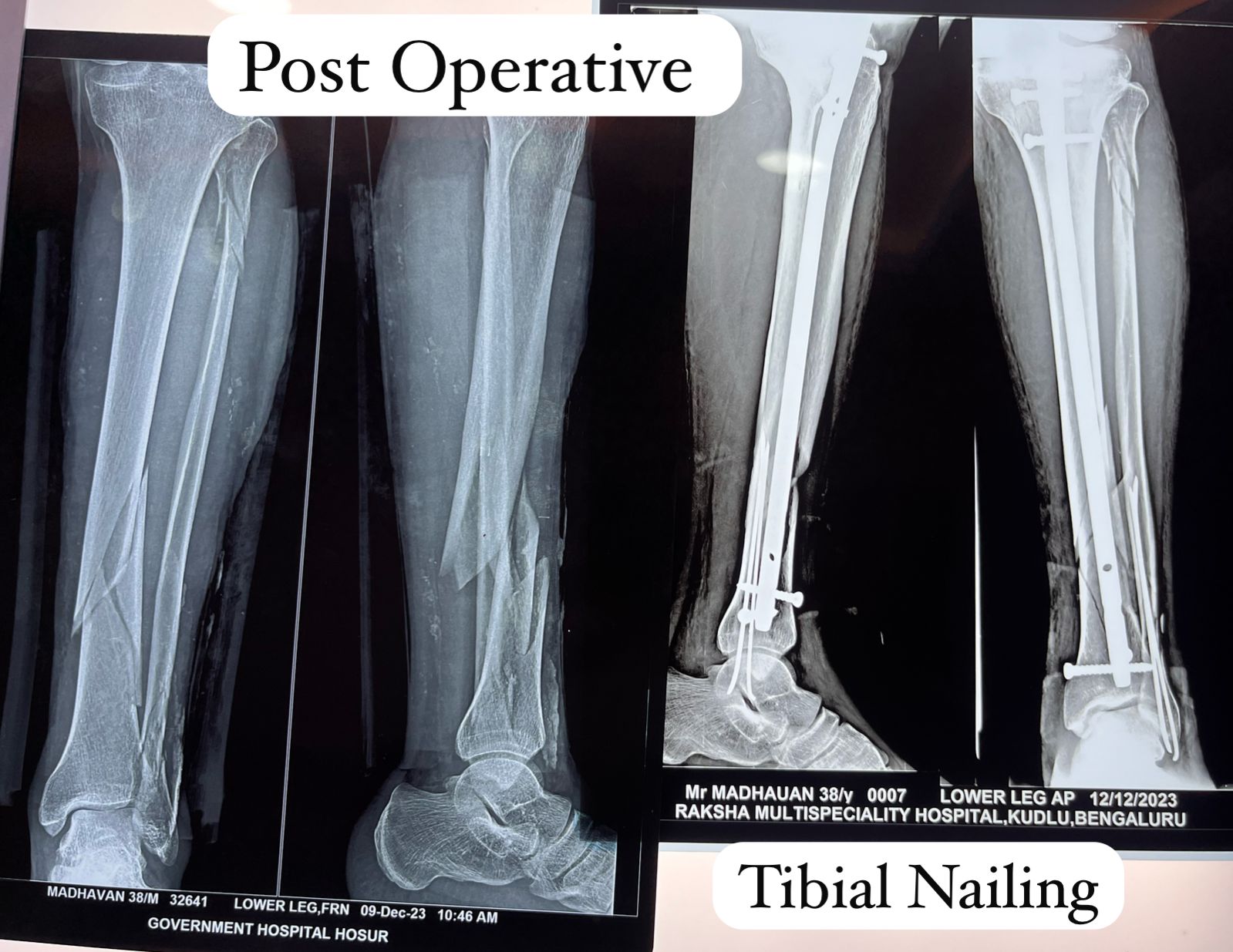 Minimally Invasive Procedures