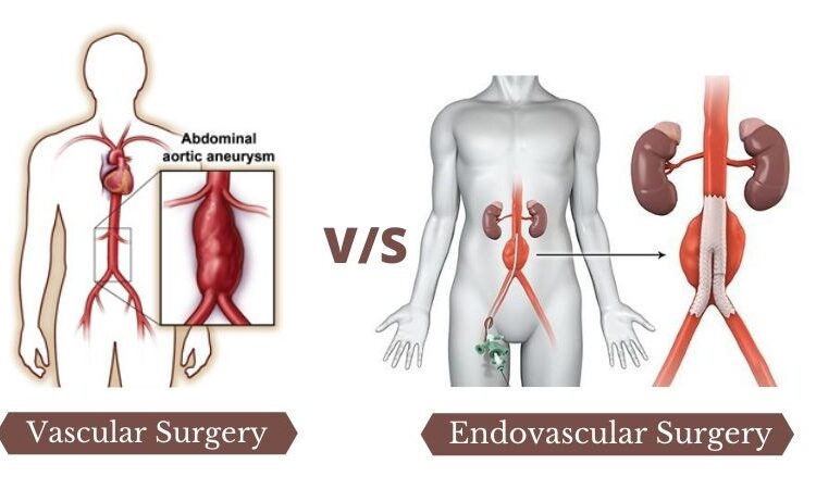 Vascular & Endovascular Surgery